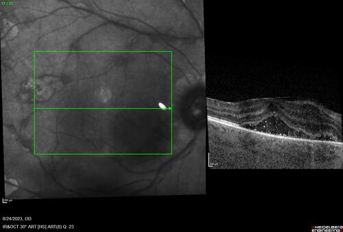 West Nile Virus Multifocal Choroiditis with later CNVM
77 year old female with vision loss in the left eye treated with Anti-VEGF
