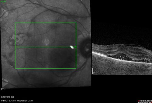 West Nile Virus Multifocal Choroiditis with later CNVM
77 year old female with vision loss in the left eye treated with Anti-VEGF
