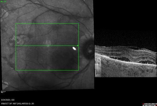 West Nile Virus Multifocal Choroiditis with later CNVM
77 year old female with vision loss in the left eye treated with Anti-VEGF
