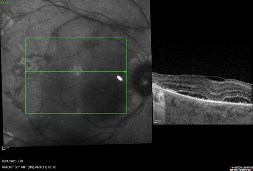 West Nile Virus Multifocal Choroiditis with later CNVM
77 year old female with vision loss in the left eye treated with Anti-VEGF

