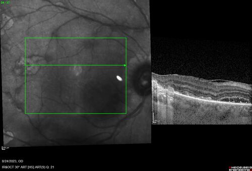 West Nile Virus Multifocal Choroiditis with later CNVM
77 year old female with vision loss in the left eye treated with Anti-VEGF
