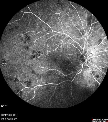 West Nile Virus Multifocal Choroiditis with later CNVM
77 year old female with vision loss in the left eye treated with Anti-VEGF
