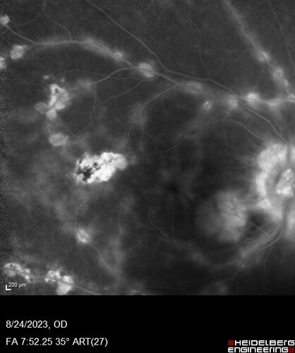 West Nile Virus Multifocal Choroiditis with later CNVM
77 year old female with vision loss in the left eye treated with Anti-VEGF
