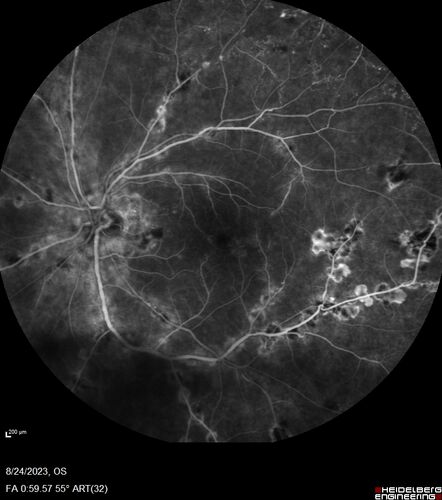 West Nile Virus Multifocal Choroiditis with later CNVM
77 year old female with vision loss in the left eye treated with Anti-VEGF
