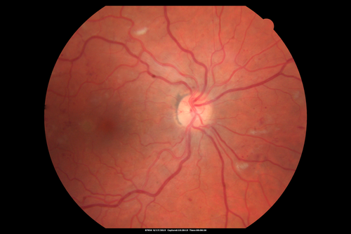 West Nile Virus Multifocal Choroiditis and diabetic retinopathy
Multifocal and clustered focal lesions are from west nile virus.  The retinopathy is probably diabetic but could also be related to west nile virus
