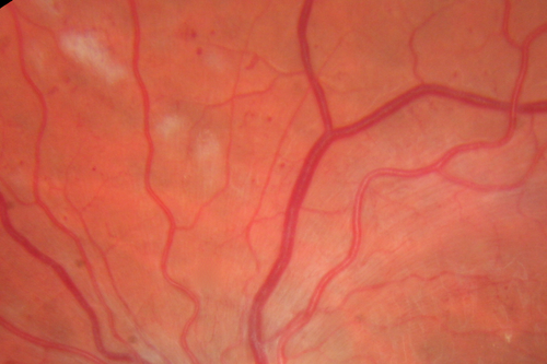 West Nile Virus Multifocal Choroiditis and diabetic retinopathy
Multifocal and clustered focal lesions are from west nile virus.  The retinopathy is probably diabetic but could also be related to west nile virus
