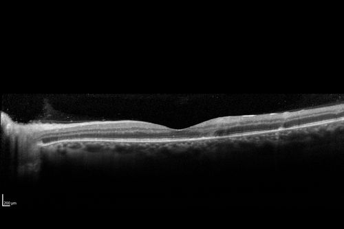 West Nile Virus Multifocal Choroiditis and diabetic retinopathy
Multifocal and clustered focal lesions are from west nile virus.  The retinopathy is probably diabetic but could also be related to west nile virus
