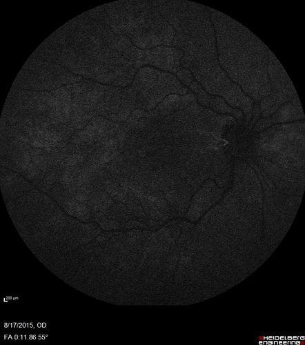 West Nile Virus Multifocal Choroiditis and diabetic retinopathy
Multifocal and clustered focal lesions are from west nile virus.  The retinopathy is probably diabetic but could also be related to west nile virus
