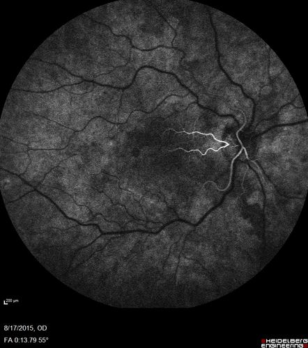West Nile Virus Multifocal Choroiditis and diabetic retinopathy
Multifocal and clustered focal lesions are from west nile virus.  The retinopathy is probably diabetic but could also be related to west nile virus
