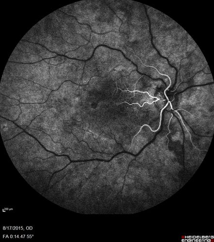 West Nile Virus Multifocal Choroiditis and diabetic retinopathy
Multifocal and clustered focal lesions are from west nile virus.  The retinopathy is probably diabetic but could also be related to west nile virus
