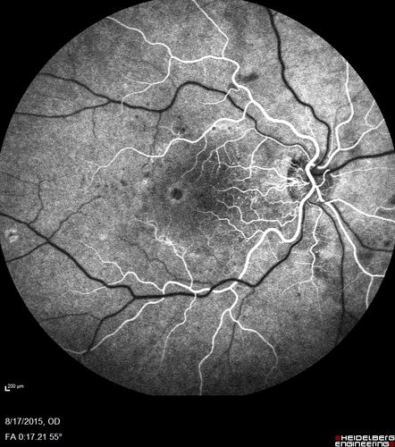 West Nile Virus Multifocal Choroiditis and diabetic retinopathy
Multifocal and clustered focal lesions are from west nile virus.  The retinopathy is probably diabetic but could also be related to west nile virus
