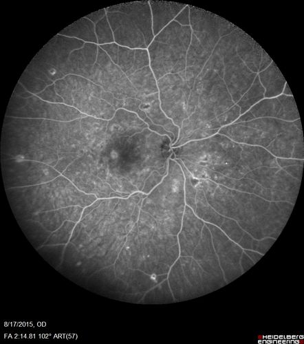 West Nile Virus Multifocal Choroiditis and diabetic retinopathy
Multifocal and clustered focal lesions are from west nile virus.  The retinopathy is probably diabetic but could also be related to west nile virus

