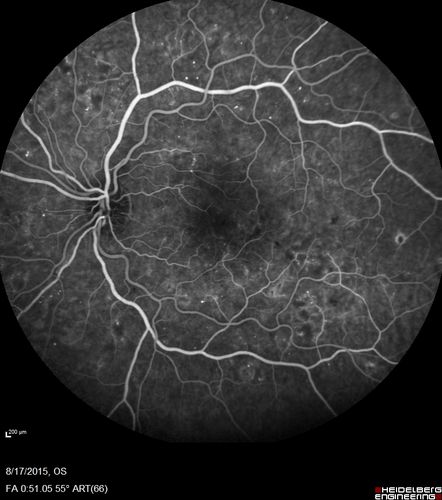 West Nile Virus Multifocal Choroiditis and diabetic retinopathy
Multifocal and clustered focal lesions are from west nile virus.  The retinopathy is probably diabetic but could also be related to west nile virus

