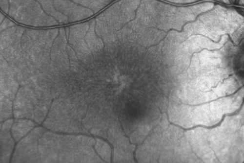 X-linked Juvenille Retinoschisis - Peripheral Retinal Vascular Anomalies - Vitreous Hemorrhage - 8 Year Old Boy
8-year-old child  OD 20/40,  OS 20/50 
OD: Vertical C/D ratio is 0.2.  There are foveal cysts.  There is also a retinal elevation inferiorly and there are patchy peripheral retinal hemorrhages.  
OS: Vertical C/D ratio is 0.2.  There are foveal cysts.  There is peripheral retinal issues with some hemorrhage in some areas of peripheral retinoschisis.  
