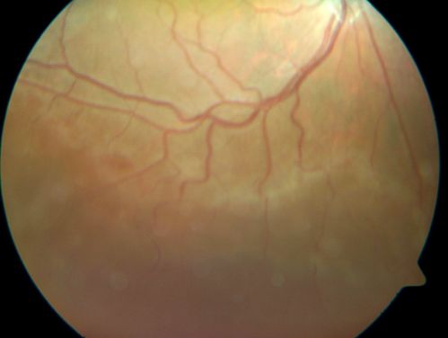 X-linked Juvenille Retinoschisis - Peripheral Retinal Vascular Anomalies - Vitreous Hemorrhage - 8 Year Old Boy
8-year-old child  OD 20/40,  OS 20/50 
OD: Vertical C/D ratio is 0.2.  There are foveal cysts.  There is also a retinal elevation inferiorly and there are patchy peripheral retinal hemorrhages.  
OS: Vertical C/D ratio is 0.2.  There are foveal cysts.  There is peripheral retinal issues with some hemorrhage in some areas of peripheral retinoschisis.  
