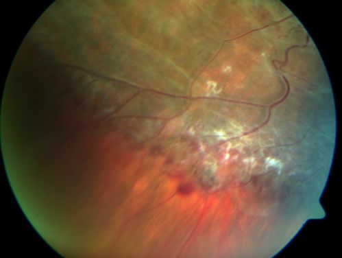 X-linked Juvenille Retinoschisis - Peripheral Retinal Vascular Anomalies - Vitreous Hemorrhage - 8 Year Old Boy
8-year-old child  OD 20/40,  OS 20/50 
OD: Vertical C/D ratio is 0.2.  There are foveal cysts.  There is also a retinal elevation inferiorly and there are patchy peripheral retinal hemorrhages.  
OS: Vertical C/D ratio is 0.2.  There are foveal cysts.  There is peripheral retinal issues with some hemorrhage in some areas of peripheral retinoschisis.  
