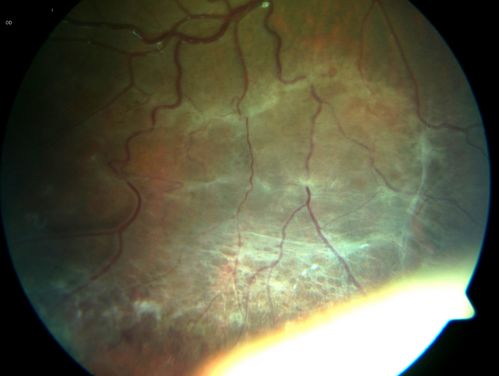X-linked Juvenille Retinoschisis - Peripheral Retinal Vascular Anomalies - Vitreous Hemorrhage - 8 Year Old Boy
8-year-old child  OD 20/40,  OS 20/50 
OD: Vertical C/D ratio is 0.2.  There are foveal cysts.  There is also a retinal elevation inferiorly and there are patchy peripheral retinal hemorrhages.  
OS: Vertical C/D ratio is 0.2.  There are foveal cysts.  There is peripheral retinal issues with some hemorrhage in some areas of peripheral retinoschisis.  
