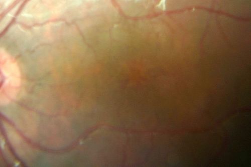 X-linked Juvenille Retinoschisis - Peripheral Retinal Vascular Anomalies - Vitreous Hemorrhage - 8 Year Old Boy
8-year-old child  OD 20/40,  OS 20/50 
OD: Vertical C/D ratio is 0.2.  There are foveal cysts.  There is also a retinal elevation inferiorly and there are patchy peripheral retinal hemorrhages.  
OS: Vertical C/D ratio is 0.2.  There are foveal cysts.  There is peripheral retinal issues with some hemorrhage in some areas of peripheral retinoschisis.  
