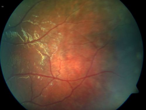 X-linked Juvenille Retinoschisis - Peripheral Retinal Vascular Anomalies - Vitreous Hemorrhage - 8 Year Old Boy
8-year-old child  OD 20/40,  OS 20/50 
OD: Vertical C/D ratio is 0.2.  There are foveal cysts.  There is also a retinal elevation inferiorly and there are patchy peripheral retinal hemorrhages.  
OS: Vertical C/D ratio is 0.2.  There are foveal cysts.  There is peripheral retinal issues with some hemorrhage in some areas of peripheral retinoschisis.  
