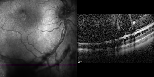 X-linked Juvenille Retinoschisis - Peripheral Retinal Vascular Anomalies - Vitreous Hemorrhage - 8 Year Old Boy
8-year-old child  OD 20/40,  OS 20/50 
OD: Vertical C/D ratio is 0.2.  There are foveal cysts.  There is also a retinal elevation inferiorly and there are patchy peripheral retinal hemorrhages.  
OS: Vertical C/D ratio is 0.2.  There are foveal cysts.  There is peripheral retinal issues with some hemorrhage in some areas of peripheral retinoschisis.  
