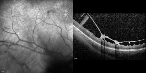 X-linked Juvenille Retinoschisis - Peripheral Retinal Vascular Anomalies - Vitreous Hemorrhage - 8 Year Old Boy
8-year-old child  OD 20/40,  OS 20/50 
OD: Vertical C/D ratio is 0.2.  There are foveal cysts.  There is also a retinal elevation inferiorly and there are patchy peripheral retinal hemorrhages.  
OS: Vertical C/D ratio is 0.2.  There are foveal cysts.  There is peripheral retinal issues with some hemorrhage in some areas of peripheral retinoschisis.  
