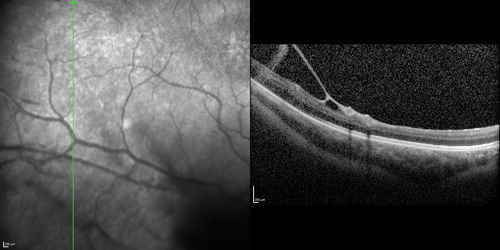 X-linked Juvenille Retinoschisis - Peripheral Retinal Vascular Anomalies - Vitreous Hemorrhage - 8 Year Old Boy
8-year-old child  OD 20/40,  OS 20/50 
OD: Vertical C/D ratio is 0.2.  There are foveal cysts.  There is also a retinal elevation inferiorly and there are patchy peripheral retinal hemorrhages.  
OS: Vertical C/D ratio is 0.2.  There are foveal cysts.  There is peripheral retinal issues with some hemorrhage in some areas of peripheral retinoschisis.  
