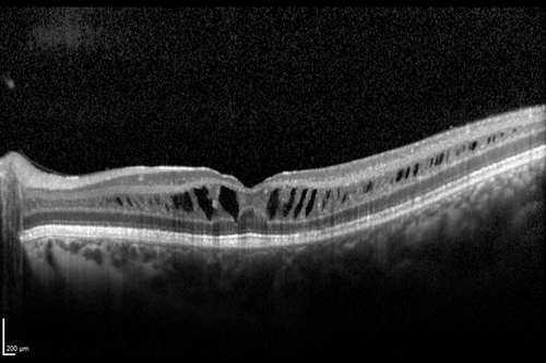 X-linked Juvenille Retinoschisis - Peripheral Retinal Vascular Anomalies - Vitreous Hemorrhage - 8 Year Old Boy
8-year-old child  OD 20/40,  OS 20/50 
OD: Vertical C/D ratio is 0.2.  There are foveal cysts.  There is also a retinal elevation inferiorly and there are patchy peripheral retinal hemorrhages.  
OS: Vertical C/D ratio is 0.2.  There are foveal cysts.  There is peripheral retinal issues with some hemorrhage in some areas of peripheral retinoschisis.  
