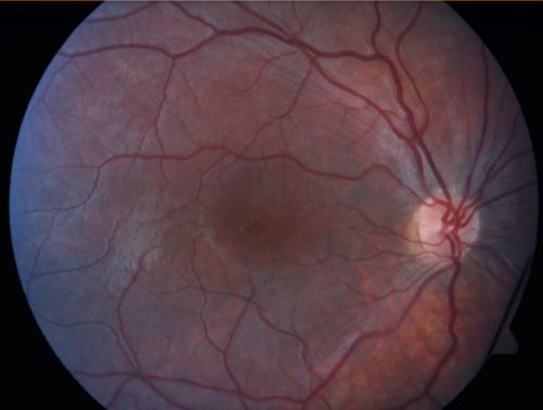 X-Linked Juvenille Retinoschisis 10 Year Old Child treated with Trusopt
10-year-old child has x-linked juvenile retinoschisis  VA 20/60, OS is 20/100.  Macula and Vision improved with Trusopt drops.
Keywords: x-linked juvenille retinoschisis;x linked;macula schisis;cme