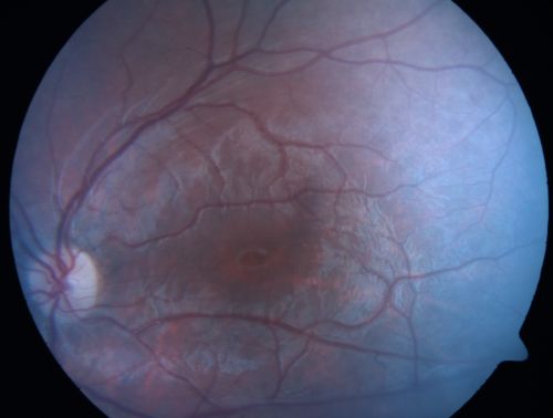 X-Linked Juvenille Retinoschisis 10 Year Old Child treated with Trusopt
10-year-old child has x-linked juvenile retinoschisis  VA 20/60, OS is 20/100.  Macula and Vision improved with Trusopt drops.
Schlüsselwörter: x-linked juvenille retinoschisis;x linked;macula schisis;cme