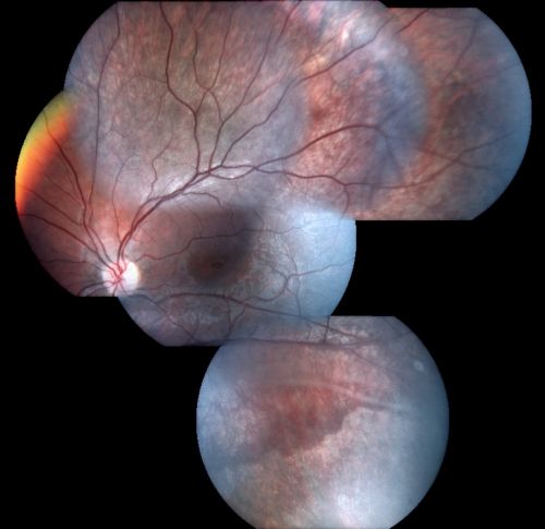 X-Linked Juvenille Retinoschisis 10 Year Old Child treated with Trusopt
10-year-old child has x-linked juvenile retinoschisis  VA 20/60, OS is 20/100.  Macula and Vision improved with Trusopt drops.
Keywords: x-linked juvenille retinoschisis;x linked;macula schisis;cme