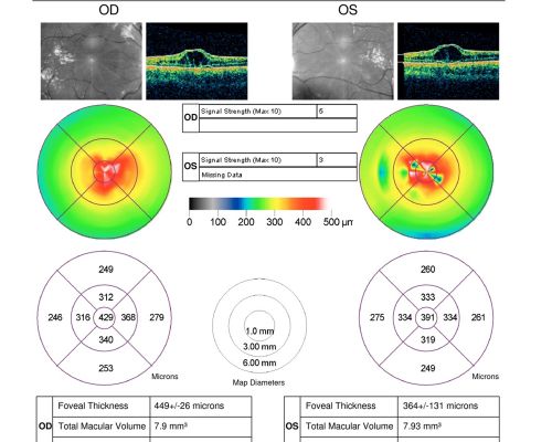 X-Linked Juvenille Retinoschisis 10 Year Old Child treated with Trusopt
10-year-old child has x-linked juvenile retinoschisis  VA 20/60, OS is 20/100.  Macula and Vision improved with Trusopt drops.
Keywords: x-linked juvenille retinoschisis;x linked;macula schisis;cme