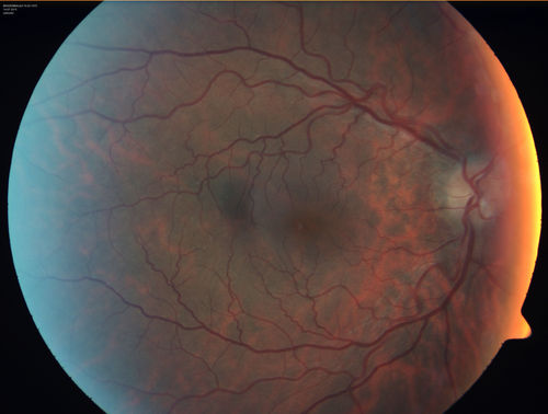 Outer retinal holes and cataract from YAG laser vitreolysis
44 year old man with 7 year history of multiple lasers for floaters.  FAF and OCT show outer retinal holes and lens has focal defects
