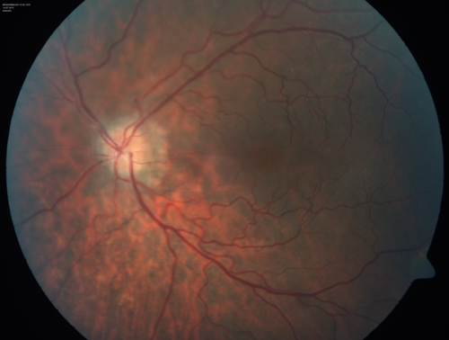 Outer retinal holes and cataract from YAG laser vitreolysis
44 year old man with 7 year history of multiple lasers for floaters.  FAF and OCT show outer retinal holes and lens has focal defects
