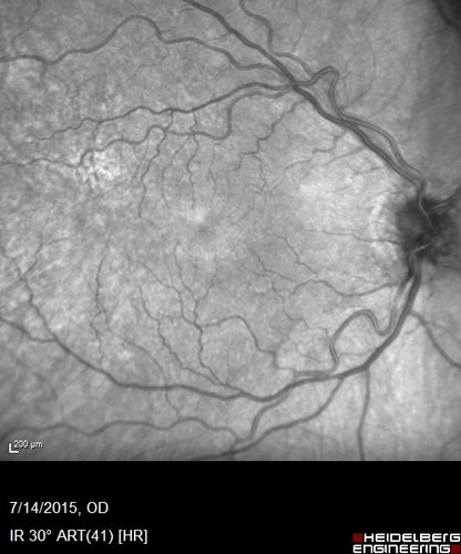 Outer retinal holes and cataract from YAG laser vitreolysis
44 year old man with 7 year history of multiple lasers for floaters.  FAF and OCT show outer retinal holes and lens has focal defects
