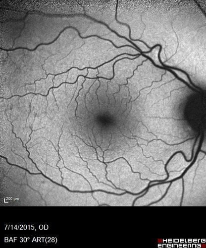 Outer retinal holes and cataract from YAG laser vitreolysis
44 year old man with 7 year history of multiple lasers for floaters.  FAF and OCT show outer retinal holes and lens has focal defects
