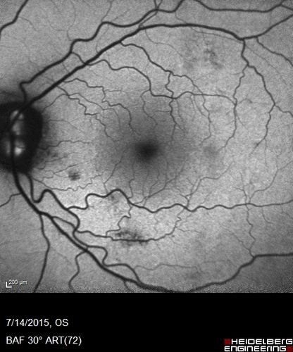 Outer retinal holes and cataract from YAG laser vitreolysis
44 year old man with 7 year history of multiple lasers for floaters.  FAF and OCT show outer retinal holes and lens has focal defects
