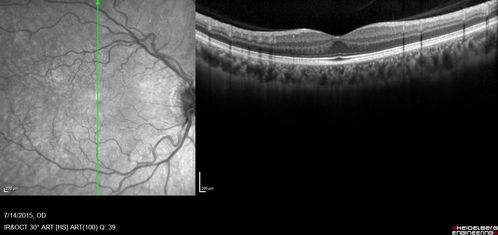 Outer retinal holes and cataract from YAG laser vitreolysis
44 year old man with 7 year history of multiple lasers for floaters.  FAF and OCT show outer retinal holes and lens has focal defects
