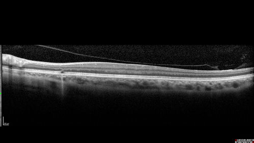 Outer retinal holes and cataract from YAG laser vitreolysis
44 year old man with 7 year history of multiple lasers for floaters.  FAF and OCT show outer retinal holes and lens has focal defects
