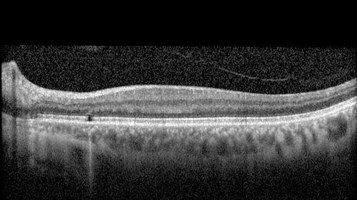 Outer retinal holes and cataract from YAG laser vitreolysis
44 year old man with 7 year history of multiple lasers for floaters.  FAF and OCT show outer retinal holes and lens has focal defects
