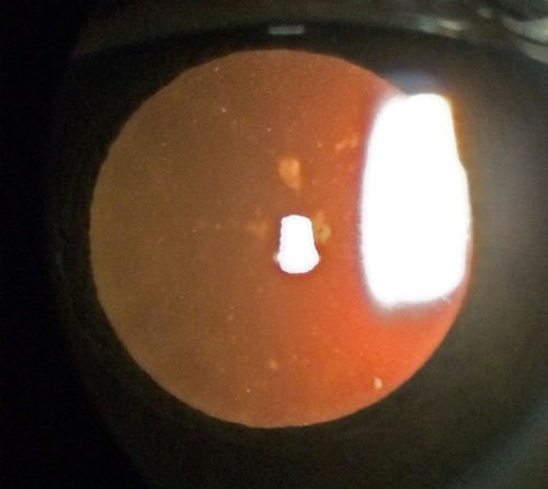 Outer retinal holes and cataract from YAG laser vitreolysis
44 year old man with 7 year history of multiple lasers for floaters.  FAF and OCT show outer retinal holes and lens has focal defects
