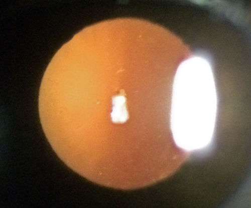 Outer retinal holes and cataract from YAG laser vitreolysis
44 year old man with 7 year history of multiple lasers for floaters.  FAF and OCT show outer retinal holes and lens has focal defects
