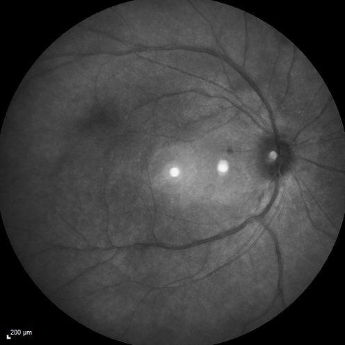 Birdshot Chorioretintis and PAMM
Patient presented with paracentral acute middle maculopathy as the presenting symptom of birdshot.  This case was published. RETINAL CASES & BRIEF REPORTS 10:151â€“153, 2016.
