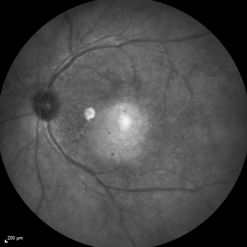 Birdshot Chorioretintis and PAMM
Patient presented with paracentral acute middle maculopathy as the presenting symptom of birdshot.  This case was published. RETINAL CASES & BRIEF REPORTS 10:151â€“153, 2016.
