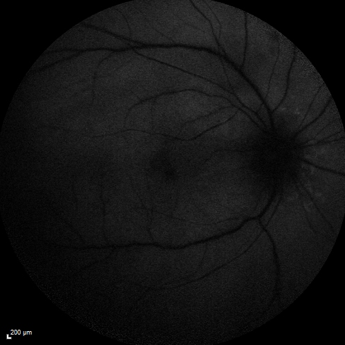 Birdshot Chorioretintis and PAMM
Patient presented with paracentral acute middle maculopathy as the presenting symptom of birdshot.  This case was published. RETINAL CASES & BRIEF REPORTS 10:151â€“153, 2016.
