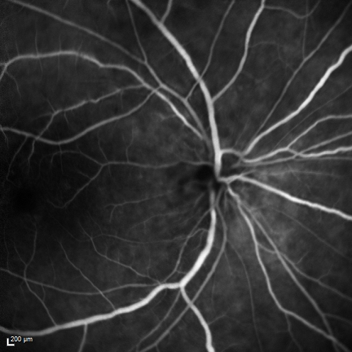 Birdshot Chorioretintis and PAMM
Patient presented with paracentral acute middle maculopathy as the presenting symptom of birdshot.  This case was published. RETINAL CASES & BRIEF REPORTS 10:151â€“153, 2016.
