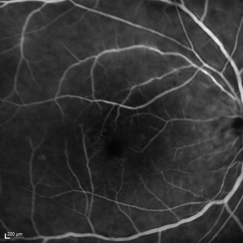Birdshot Chorioretintis and PAMM
Patient presented with paracentral acute middle maculopathy as the presenting symptom of birdshot.  This case was published. RETINAL CASES & BRIEF REPORTS 10:151â€“153, 2016.
