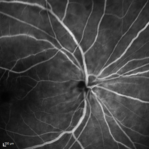Birdshot Chorioretintis and PAMM
Patient presented with paracentral acute middle maculopathy as the presenting symptom of birdshot.  This case was published. RETINAL CASES & BRIEF REPORTS 10:151â€“153, 2016.
