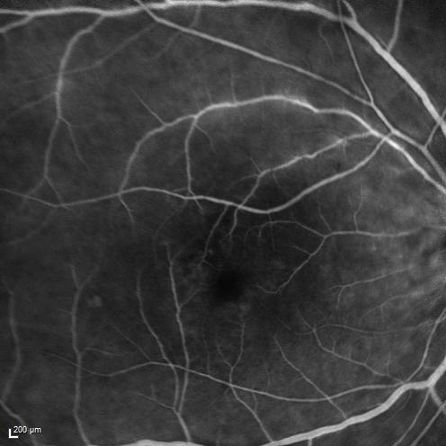 Birdshot Chorioretintis and PAMM
Patient presented with paracentral acute middle maculopathy as the presenting symptom of birdshot.  This case was published. RETINAL CASES & BRIEF REPORTS 10:151â€“153, 2016.
