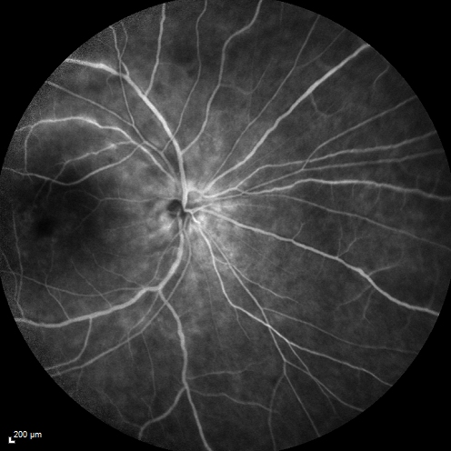 Birdshot Chorioretintis and PAMM
Patient presented with paracentral acute middle maculopathy as the presenting symptom of birdshot.  This case was published. RETINAL CASES & BRIEF REPORTS 10:151â€“153, 2016.
