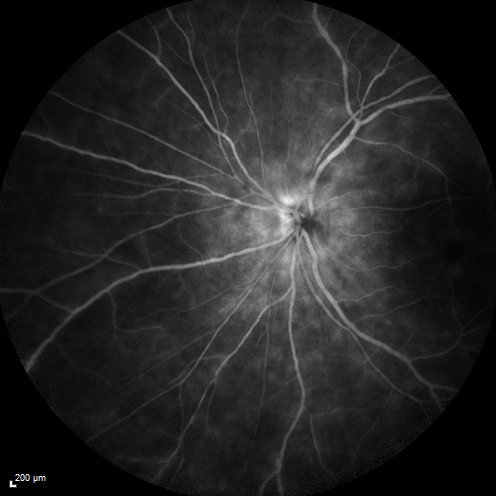 Birdshot Chorioretintis and PAMM
Patient presented with paracentral acute middle maculopathy as the presenting symptom of birdshot.  This case was published. RETINAL CASES & BRIEF REPORTS 10:151â€“153, 2016.
